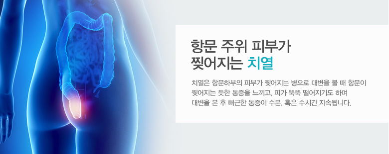 항문 주위 피부가 찢어지는 치열